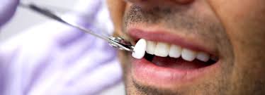 Ce qu’il faut savoir avant d’obtenir des facettes dentaires
